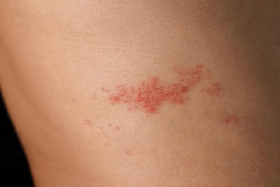 Shingles Treatment